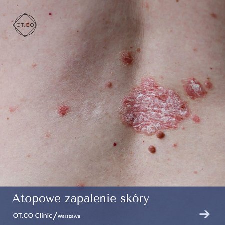 atopowe zapalenie skóry